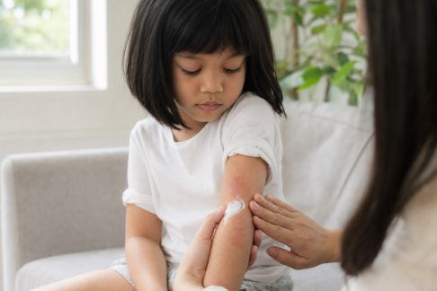 Éczéma chez l’enfant : conseils pratiques pour soulager au quotidien